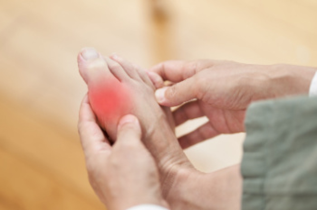 Comparing Symptoms of Gout and Bunions