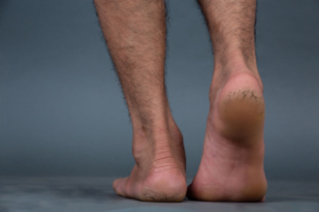 Reasons for Cracked Heels