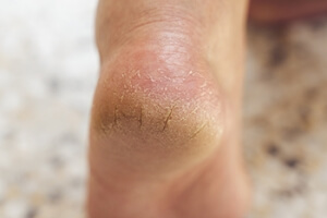 Pretty Feet for Summer