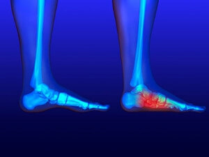 Finding the Right Shoes for Flat Feet