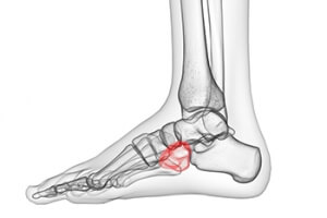 Cuboid Syndrome and Possible Causes