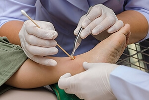 What You Need to Know to Prevent Diabetic Foot Ulcers