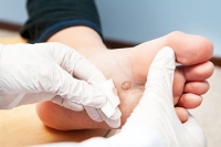 Managing Skin Warts on the Feet