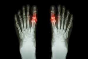 Foods That Can Trigger Gout