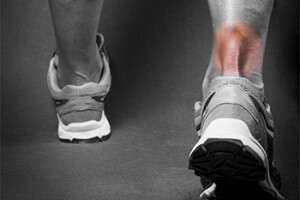 Facts About  Achilles Tendon Ruptures