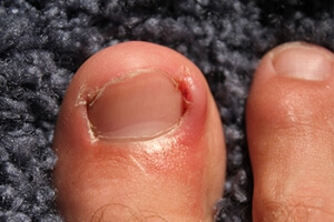Ingrown Toenail Management Techniques