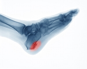 Easing Heel Spur Pain