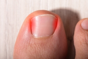 What Does an Ingrown Toenail Look Like?