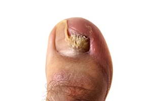What You Should Know About Onychomycosis