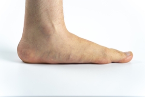 When Flat Feet Are Problematic